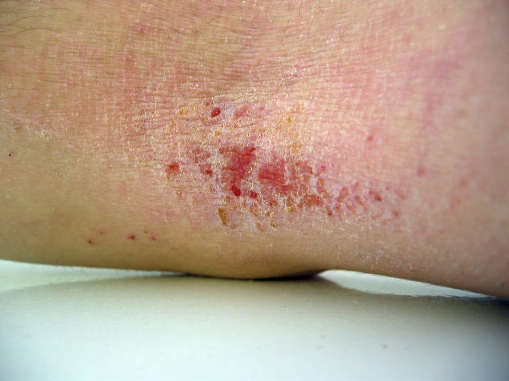 Eczema