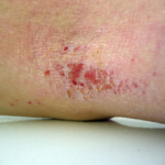 Eczema